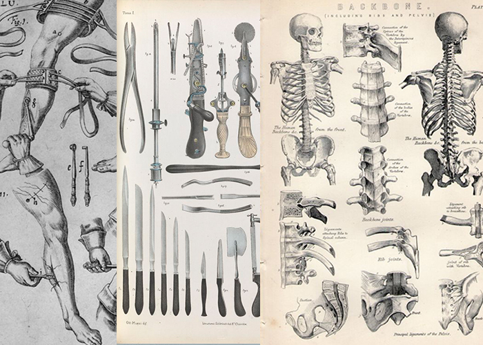 Uma amputação, um paciente e três mortos: conheça a sanguinolenta medicina do século XIX